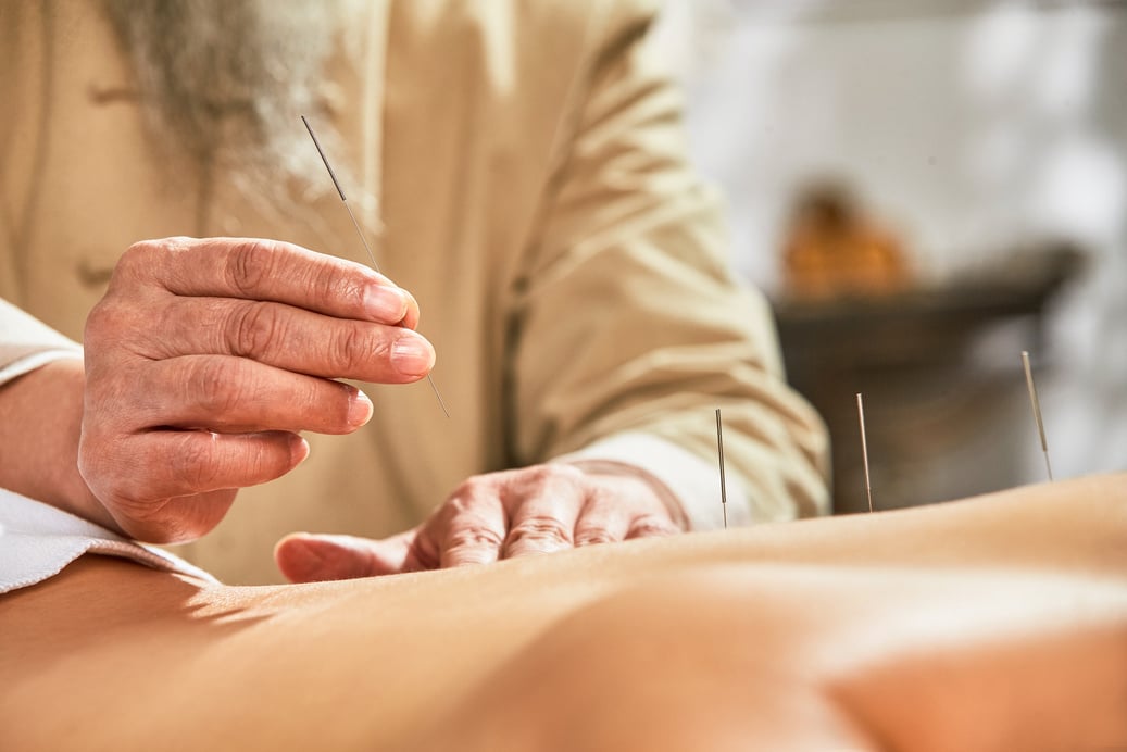 The doctor of traditional Chinese medicine acupuncture